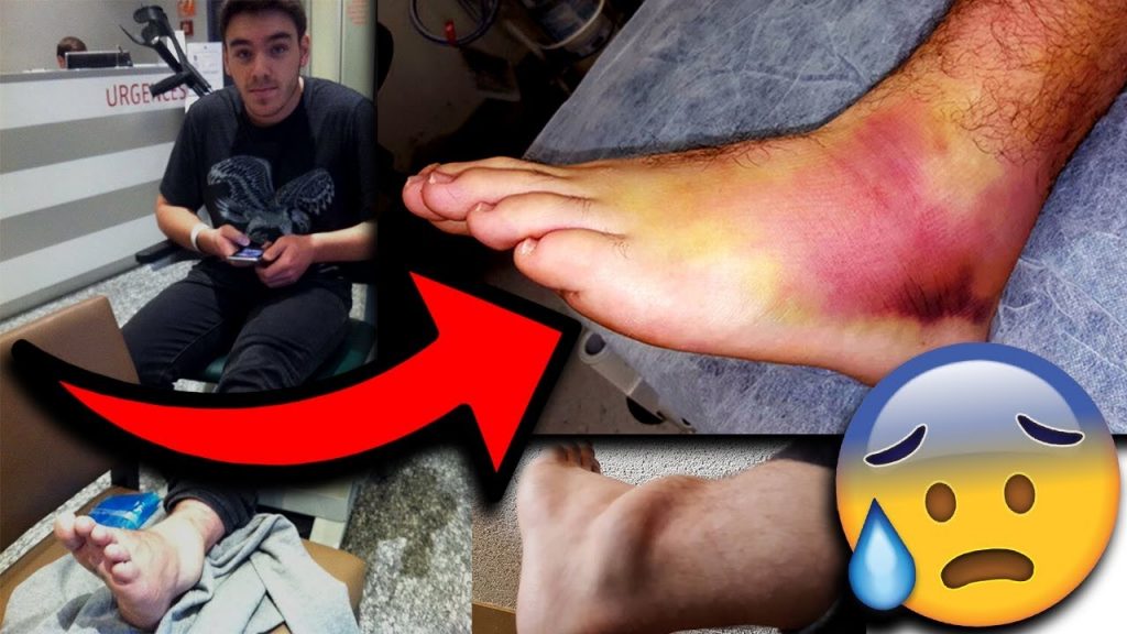 Ma PIRE blessure en BMX