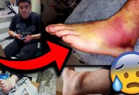 Ma PIRE blessure en BMX